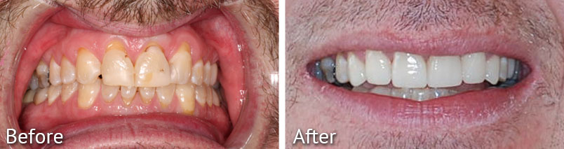 Emory Smile Makeover Before and After from HighPointe Dental