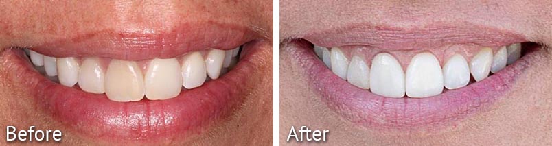 Jackie Smile Teeth Whitening Before and After from HighPointe Dental