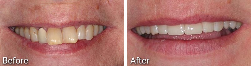 Janice Smile Makeover Before and After from HighPointe Dental