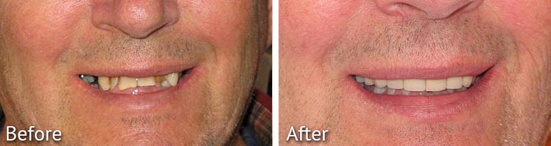 Richard Smile Makeover Before and After from HighPointe Dental