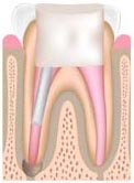 Animated cross section of a tooth after a root canal but before a crown