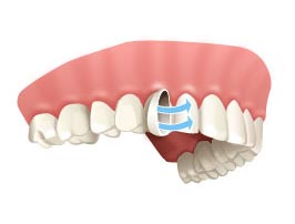 Animated image of a dental veneer