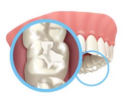 Animated Image of a dental filling