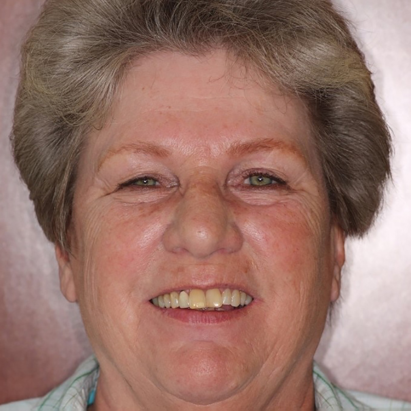 Image of Janice, before treament at High Pointe Park Dental in Thornton, CO.