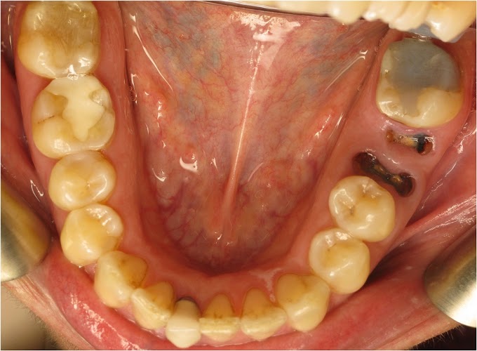 Image of Missing Teeth